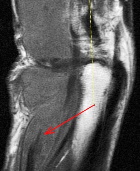 Figure 6 for case Rheumatoid arthritis ( RID3561 )